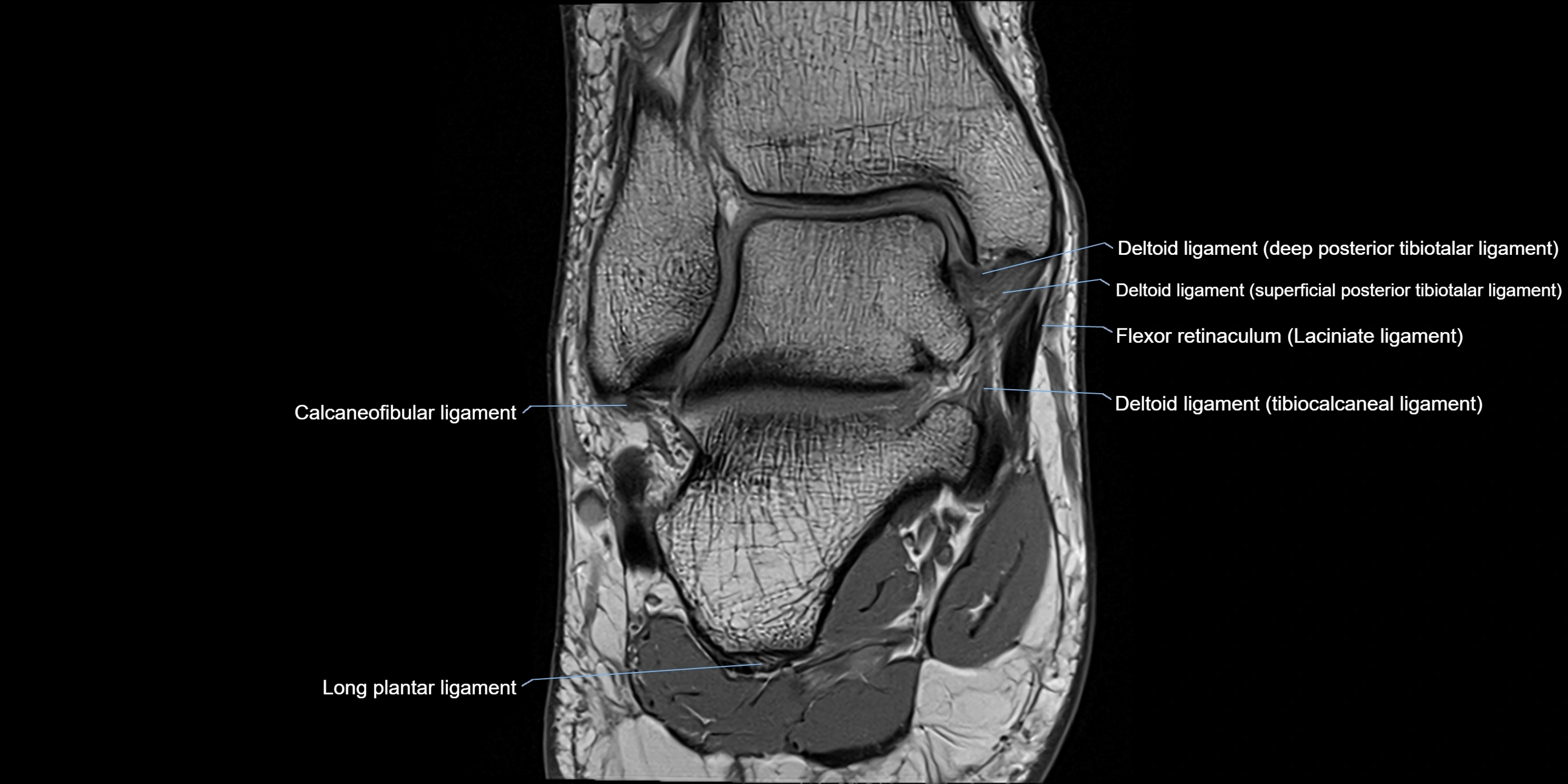 MRI Ankle coronal ligaments cross sectional anatomy 3T  radiology  image-img-00001-00013.webp
